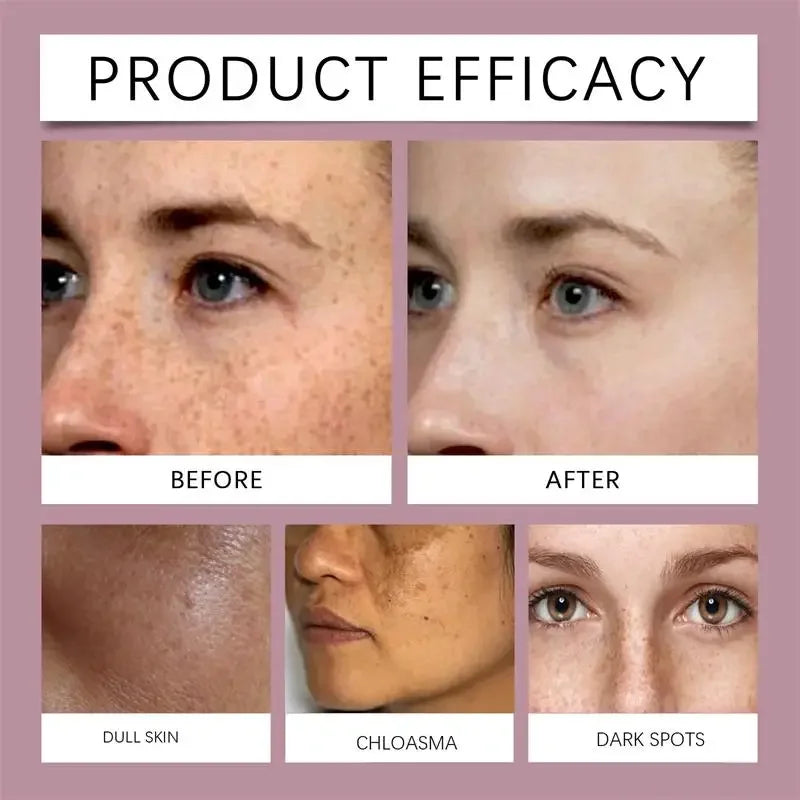 Crème blanchissante pour taches de rousseur, mélasma, taches brunes, produits d'élimination de la pigmentation, estompe les taches, répare la mélanine, illumine les soins coréens pour la peau. Nouveau