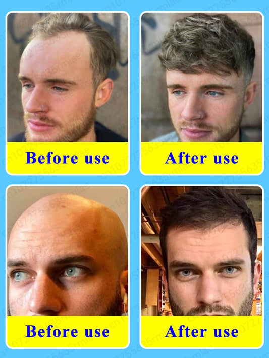Les experts XXX ont certifié le produit le plus efficace pour la croissance capillaire. Dites adieu à la calvitie en 7 jours. Également efficace pour la barbe et les cheveux.