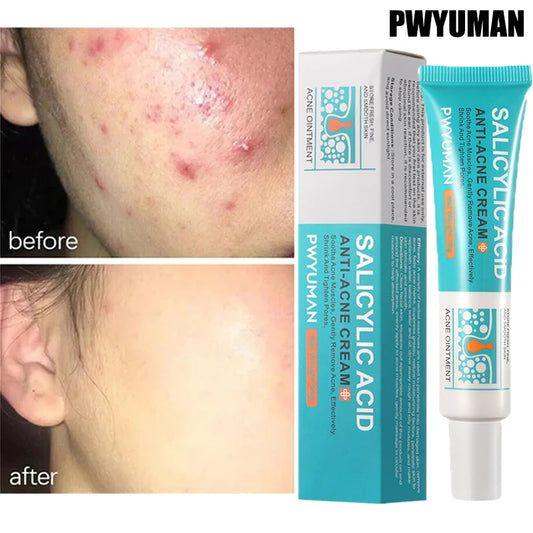 Crème anti-acné à l'acide salicylique F W, réparation anti-acné, rougeurs, boutons, nettoyage en profondeur, contrôle du sébum, soins hydratants pour la peau