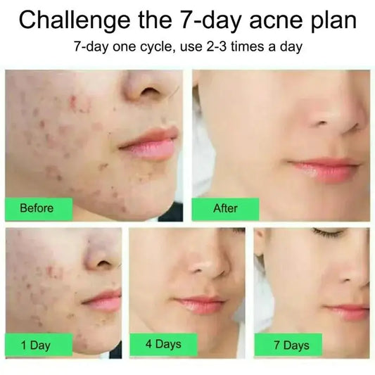 Crème anti-acné à l'acide salicylique F W, réparation anti-acné, rougeurs, boutons, nettoyage en profondeur, contrôle du sébum, soins hydratants pour la peau
