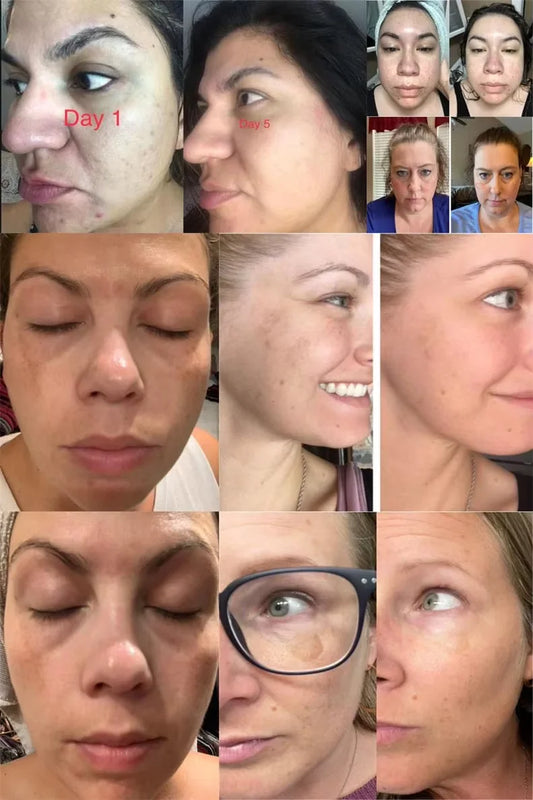 Crème blanchissante pour taches de rousseur, mélasma, taches brunes, produits d'élimination de la pigmentation, estompe les taches, répare la mélanine, illumine les soins coréens pour la peau. Nouveau