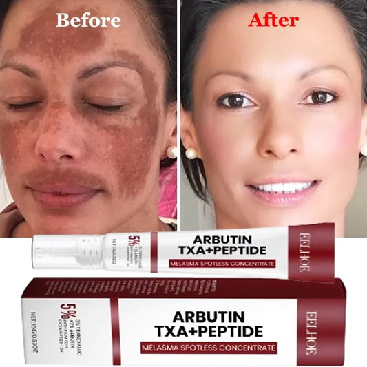 Crème blanchissante pour taches de rousseur, mélasma, taches brunes, produits d'élimination de la pigmentation, estompe les taches, répare la mélanine, illumine les soins coréens pour la peau. Nouveau