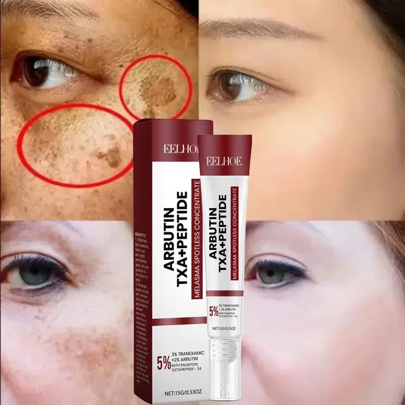 Crème blanchissante pour taches de rousseur, mélasma, taches brunes, produits d'élimination de la pigmentation, estompe les taches, répare la mélanine, illumine les soins coréens pour la peau. Nouveau