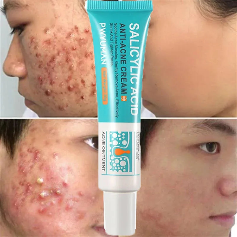 Crème anti-acné à l'acide salicylique F W, réparation anti-acné, rougeurs, boutons, nettoyage en profondeur, contrôle du sébum, soins hydratants pour la peau